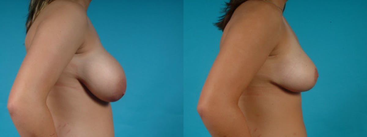 Breast Reduction/Lift Before & After Gallery - Patient 325536 - Image 5