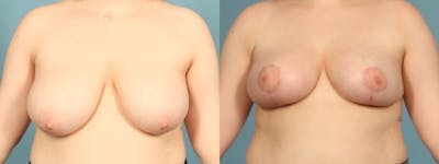 Breast Reduction/Lift Before & After Gallery - Patient 398867 - Image 1