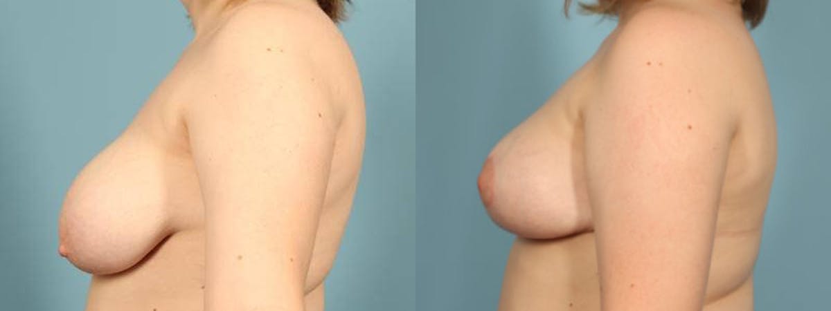Breast Reduction/Lift Before & After Gallery - Patient 398867 - Image 4