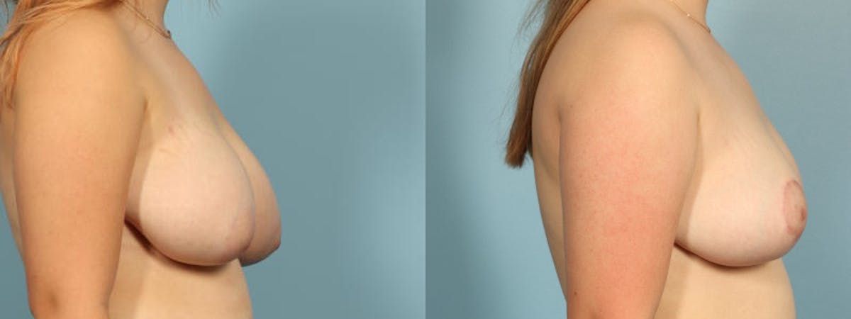 Breast Reduction/Lift Before & After Gallery - Patient 241449 - Image 5