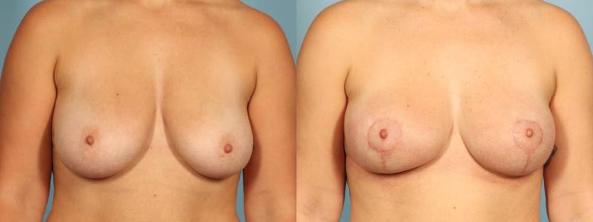 Breast Reduction/Lift Before & After Gallery - Patient 164258 - Image 1