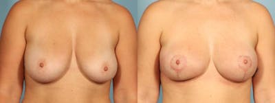 Breast Reduction/Lift Before & After Gallery - Patient 164258 - Image 1