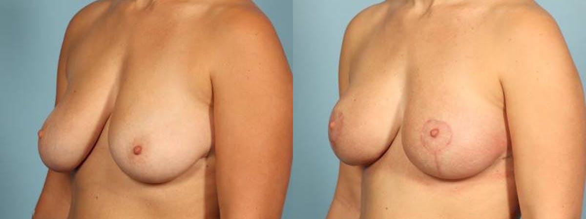 Breast Reduction/Lift Before & After Gallery - Patient 164258 - Image 2