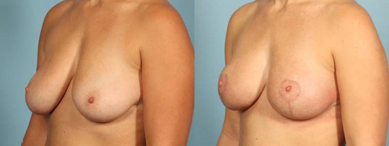 Breast Reduction/Lift Before & After Gallery - Patient 164258 - Image 2