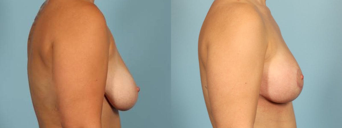 Breast Reduction/Lift Before & After Gallery - Patient 164258 - Image 5