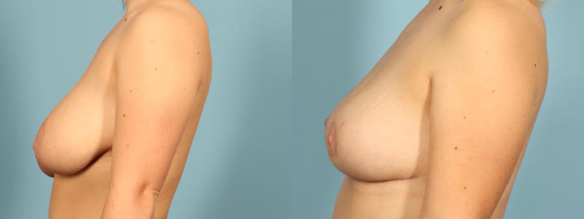 Breast Reduction/Lift Before & After Gallery - Patient 165743 - Image 4