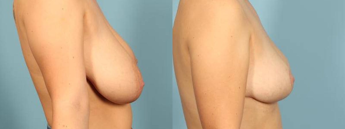 Breast Reduction/Lift Before & After Gallery - Patient 165743 - Image 5