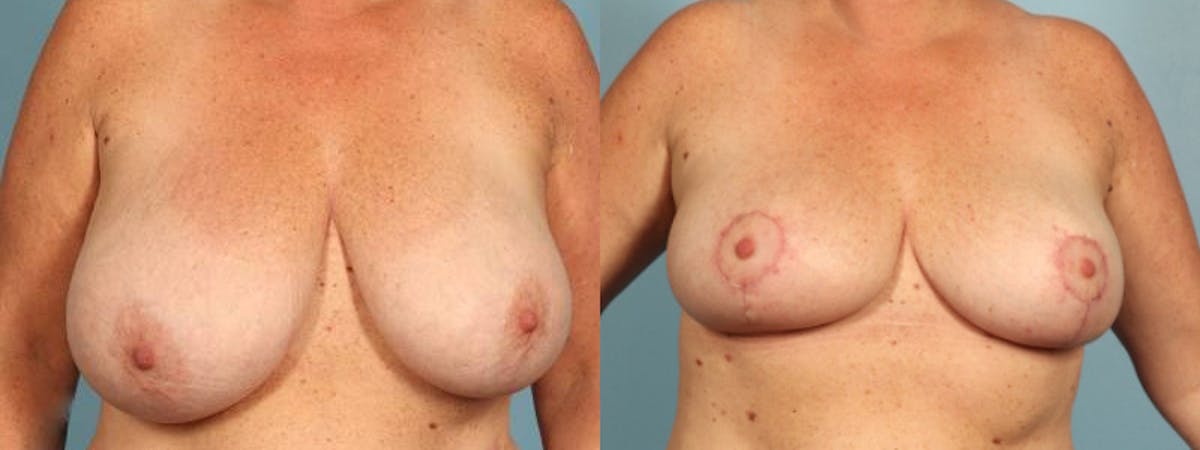 Breast Reduction/Lift Before & After Gallery - Patient 426635 - Image 1