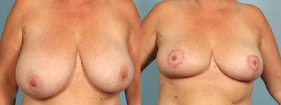 Breast Reduction/Lift Before & After Gallery - Patient 426635 - Image 1