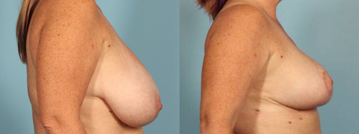 Breast Reduction/Lift Before & After Gallery - Patient 426635 - Image 3