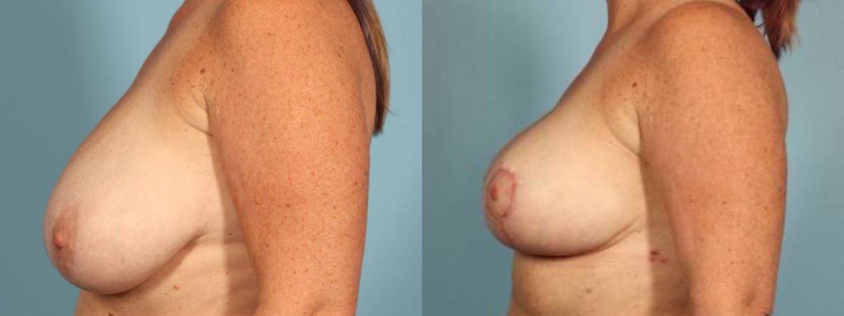 Breast Reduction/Lift Before & After Gallery - Patient 426635 - Image 4