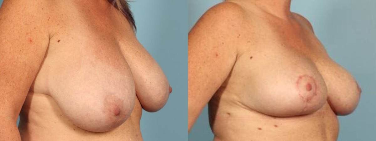 Breast Reduction/Lift Before & After Gallery - Patient 426635 - Image 5