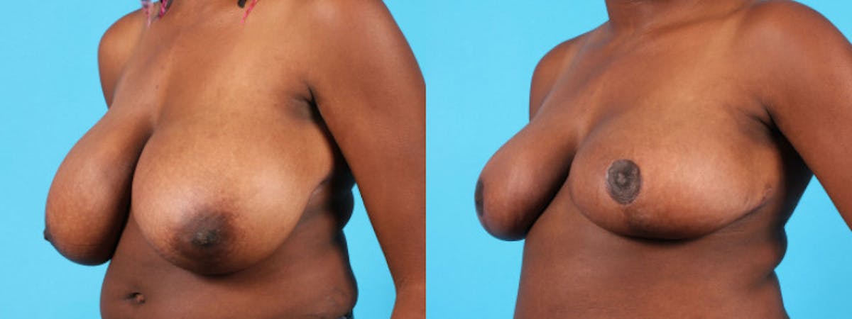 Breast Reduction/Lift Before & After Gallery - Patient 159981 - Image 2
