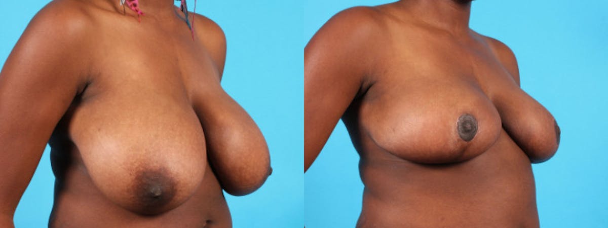 Breast Reduction/Lift Before & After Gallery - Patient 159981 - Image 3