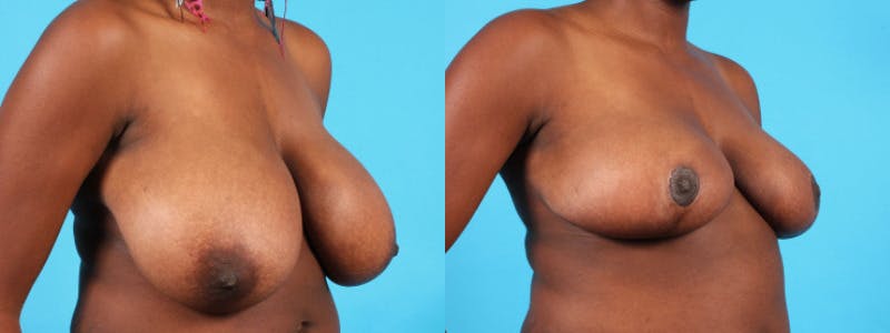 Breast Reduction/Lift Before & After Gallery - Patient 159981 - Image 3