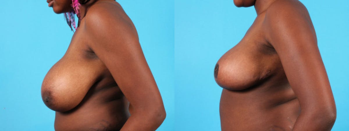 Breast Reduction/Lift Before & After Gallery - Patient 159981 - Image 4