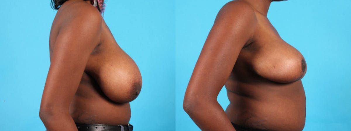 Breast Reduction/Lift Before & After Gallery - Patient 159981 - Image 5