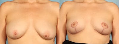 Breast Reduction/Lift Before & After Gallery - Patient 359874 - Image 1