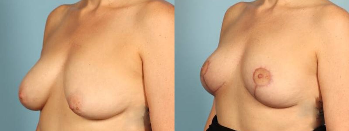 Breast Reduction/Lift Before & After Gallery - Patient 359874 - Image 2