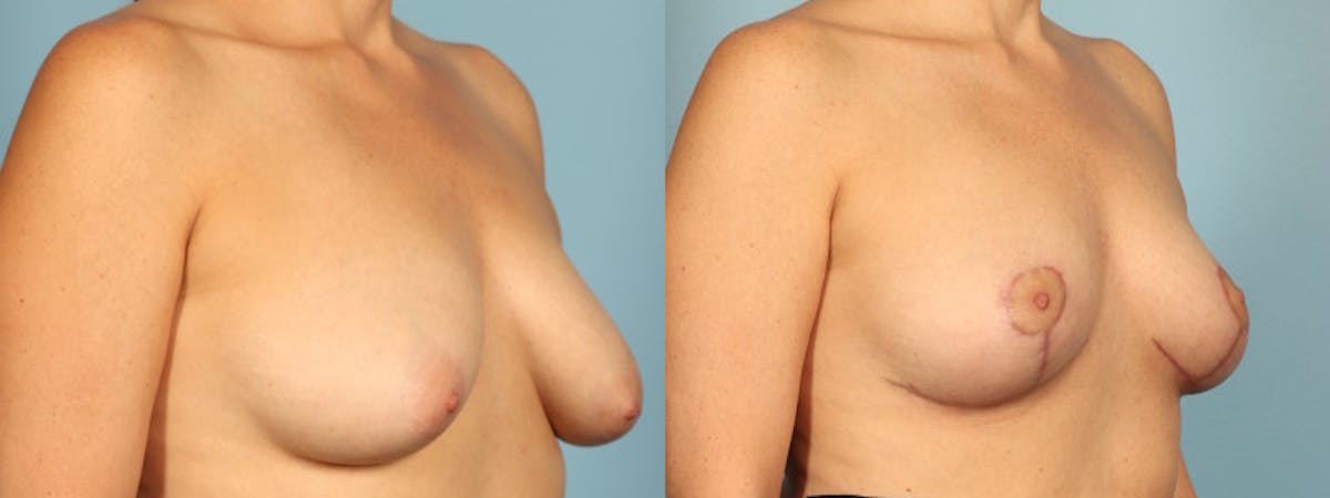 Breast Reduction/Lift Before & After Gallery - Patient 359874 - Image 3