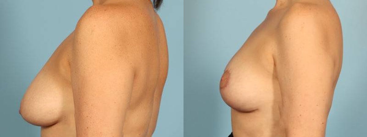 Breast Reduction/Lift Before & After Gallery - Patient 359874 - Image 4