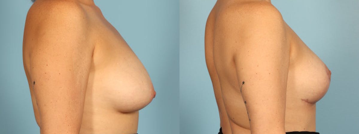 Breast Reduction/Lift Before & After Gallery - Patient 359874 - Image 5