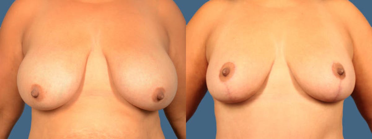 Breast Reduction/Lift Before & After Gallery - Patient 314439 - Image 1