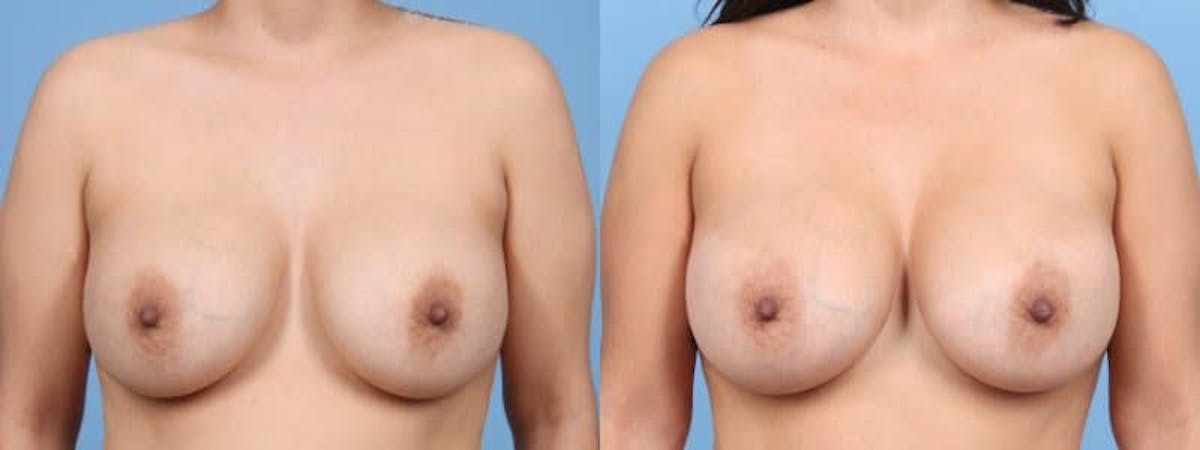 Implant Revision Before & After Gallery - Patient 363165 - Image 1