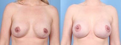 Implant Revision Before & After Gallery - Patient 308101 - Image 1
