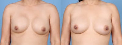 Implant Revision Before & After Gallery - Patient 521028 - Image 1