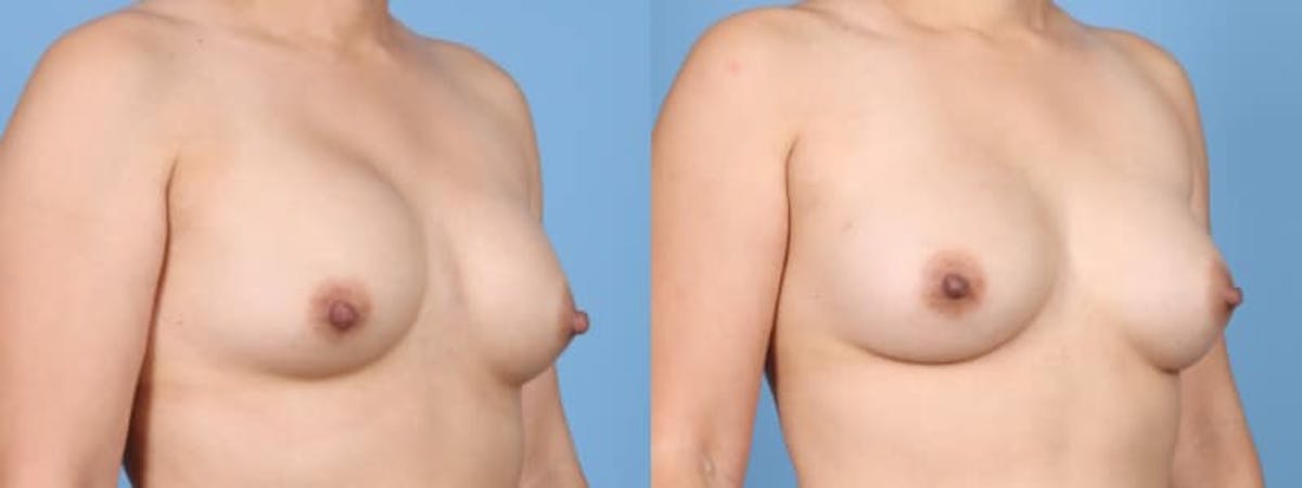 Implant Revision Before & After Gallery - Patient 521028 - Image 2