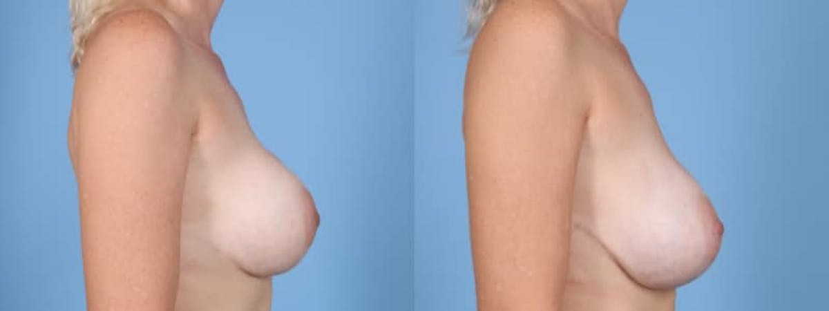 Implant Revision Before & After Gallery - Patient 212737 - Image 6