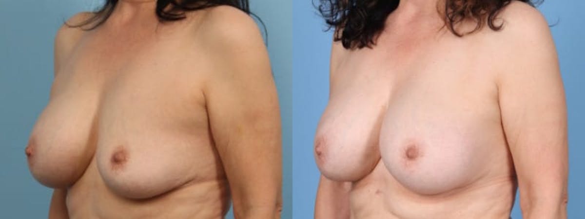 Implant Revision Before & After Gallery - Patient 331816 - Image 2