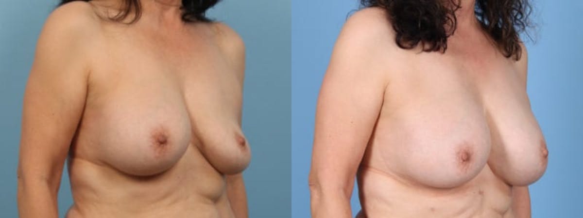 Implant Revision Before & After Gallery - Patient 331816 - Image 3