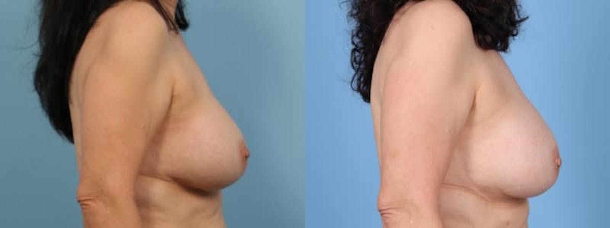 Implant Revision Before & After Gallery - Patient 331816 - Image 5