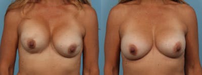 Implant Revision Before & After Gallery - Patient 861017 - Image 1