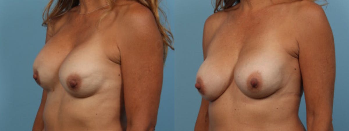 Implant Revision Before & After Gallery - Patient 861017 - Image 3