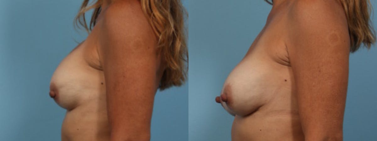 Implant Revision Before & After Gallery - Patient 861017 - Image 4