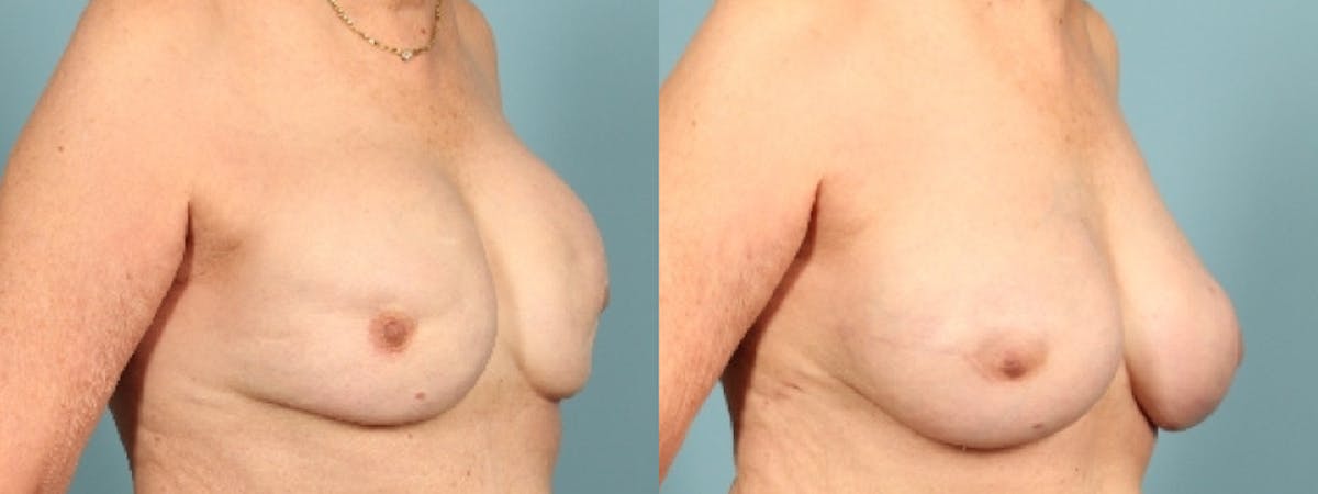 Implant Revision Before & After Gallery - Patient 291482 - Image 2