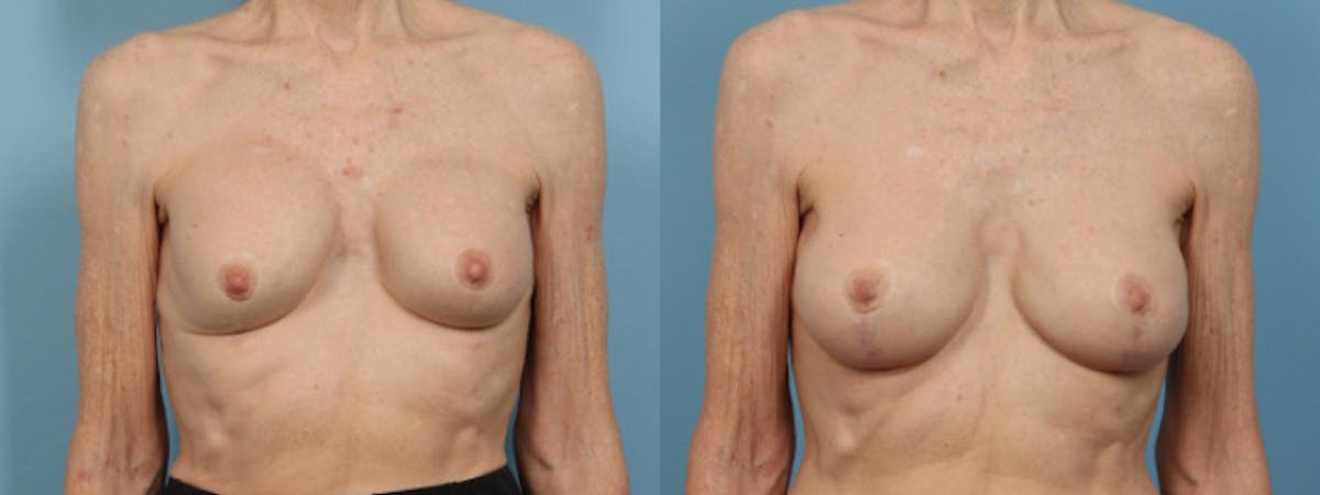 Implant Revision Before & After Gallery - Patient 353137 - Image 1