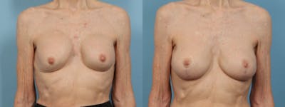Implant Revision Before & After Gallery - Patient 353137 - Image 1