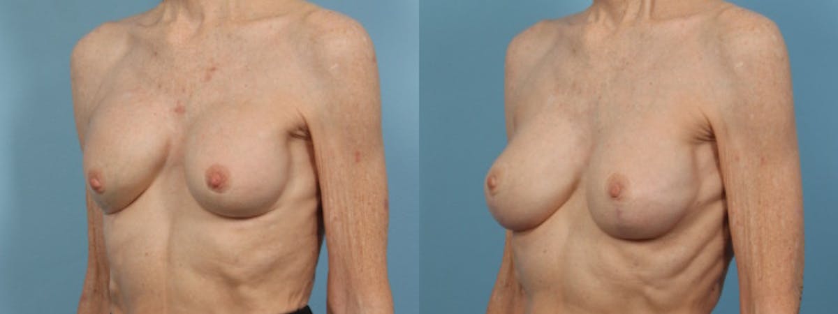 Implant Revision Before & After Gallery - Patient 353137 - Image 2