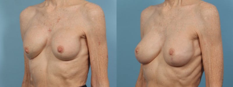 Implant Revision Before & After Gallery - Patient 353137 - Image 2
