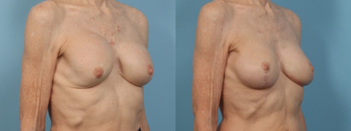 Implant Revision Before & After Gallery - Patient 353137 - Image 3