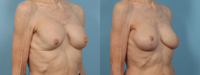 Implant Revision Before & After Gallery - Patient 353137 - Image 3