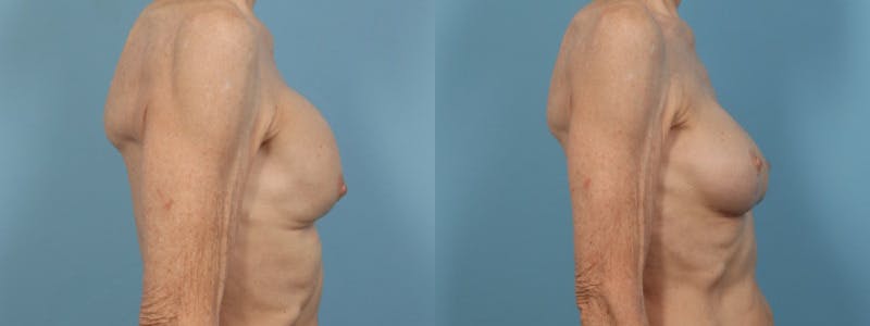 Implant Revision Before & After Gallery - Patient 353137 - Image 4