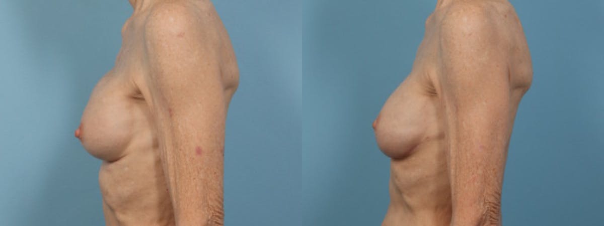 Implant Revision Before & After Gallery - Patient 353137 - Image 5