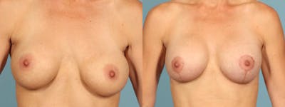 Implant Revision Before & After Gallery - Patient 398041 - Image 1