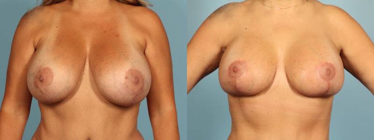 Implant Revision Before & After Gallery - Patient 189218 - Image 1