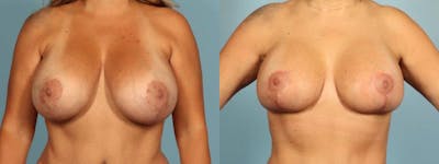 Implant Revision Before & After Gallery - Patient 189218 - Image 1